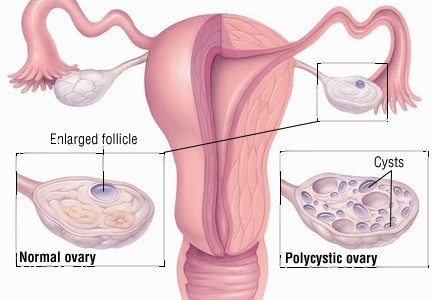 Повышение фертильности у женщин с СПКЯ (синдром поликистозных яичников)